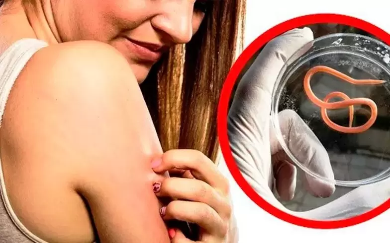 մարմնի մեջ մակաբույծների պատճառով քոր առաջացում և գրգռում